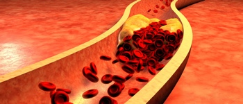 Obrázek- Arterioskleróza