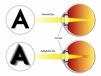 szembetegségek hyperopia myopia astigmatismus