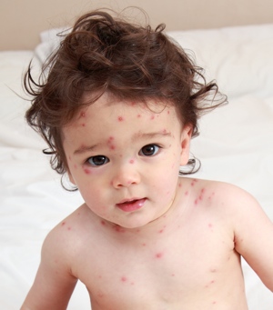 Dítě s neštovicemi