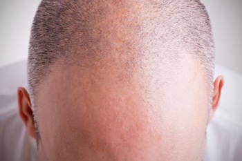 Fotka muže, který trpí ztrátou vlasů.